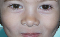Online Fundraising - Donate to National Alopecia Areata Foundation
